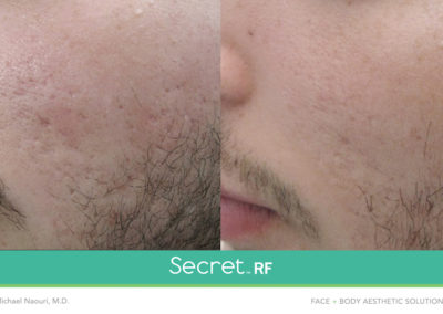 secret-rf-microneedling-acne-scars-before-after-photos