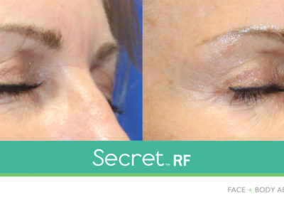 secret-rf-microneedling-crows-feet-before-after-photos