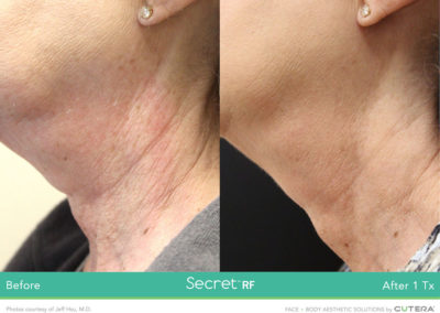 secret-rf-microneedling-neck-wrinkles-before-after-photo